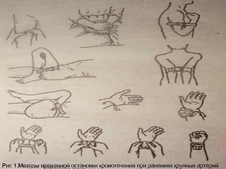 Рис 1. Методы временной остановки кровотечения при ранениях крупных артерий 