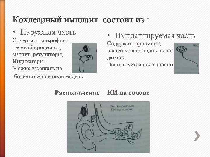 Схема работы кохлеарного импланта