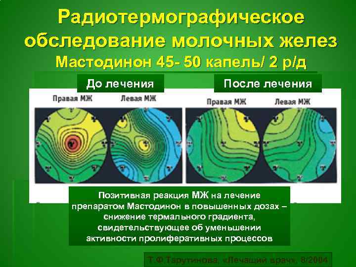 Радиотермографическое обследование молочных желез Мастодинон 45 - 50 капель/ 2 р/д До лечения После