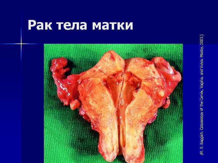 (M. S. Baggish. Colposcopy of the Cervix, Vagina, and Vulva. Mosby, 2003. ) Рак