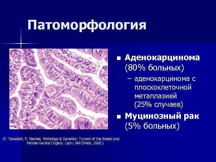 Патоморфология n Аденокарцинома (80% больных) – аденокарцинома с плоскоклеточной метаплазией (25% случаев) n (F.