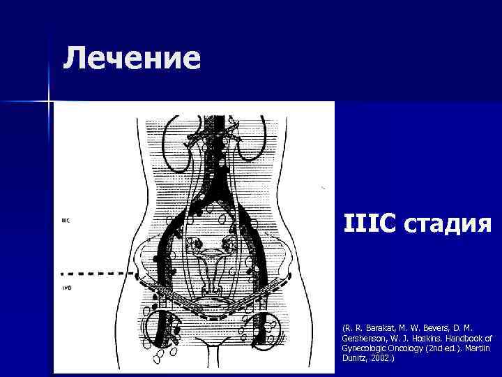 Лечение IIIC стадия (R. R. Barakat, M. W. Bevers, D. M. Gershenson, W. J.