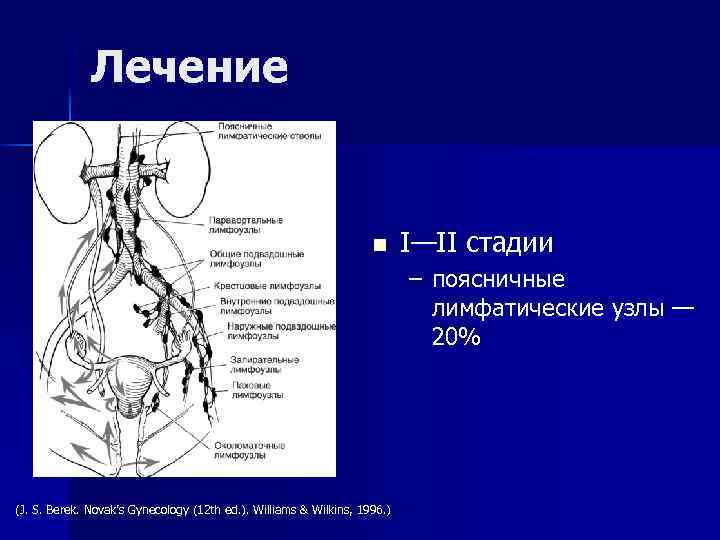 Лечение n I—II стадии – поясничные лимфатические узлы — 20% (J. S. Berek. Novak’s