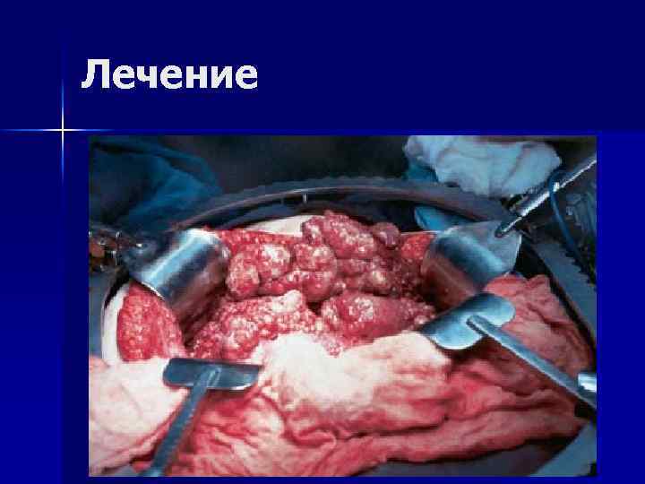 Лечение 