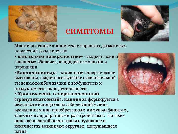 симптомы Многочисленные клинические варианты дрожжевых поражений разделяют на § кандидозы поверхностные -гладкой кожи и