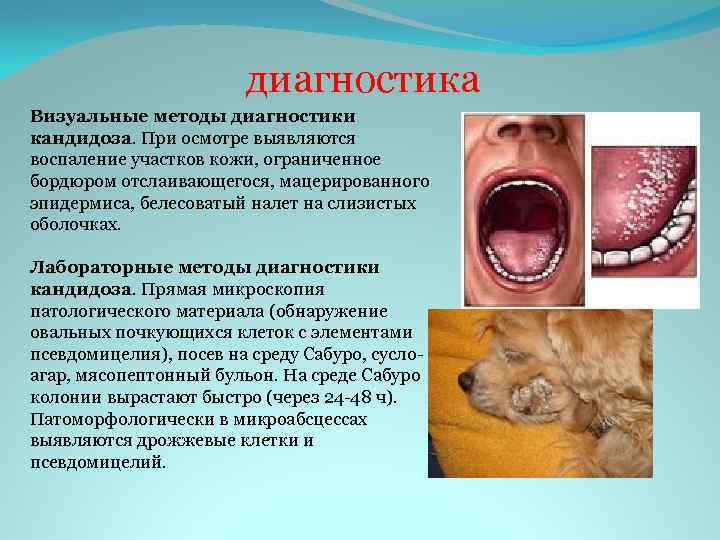 диагностика Визуальные методы диагностики кандидоза. При осмотре выявляются воспаление участков кожи, ограниченное бордюром отслаивающегося,