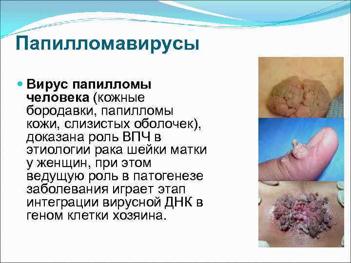Папилломавирусы Вирус папилломы человека (кожные бородавки, папилломы кожи, слизистых оболочек), доказана роль ВПЧ в