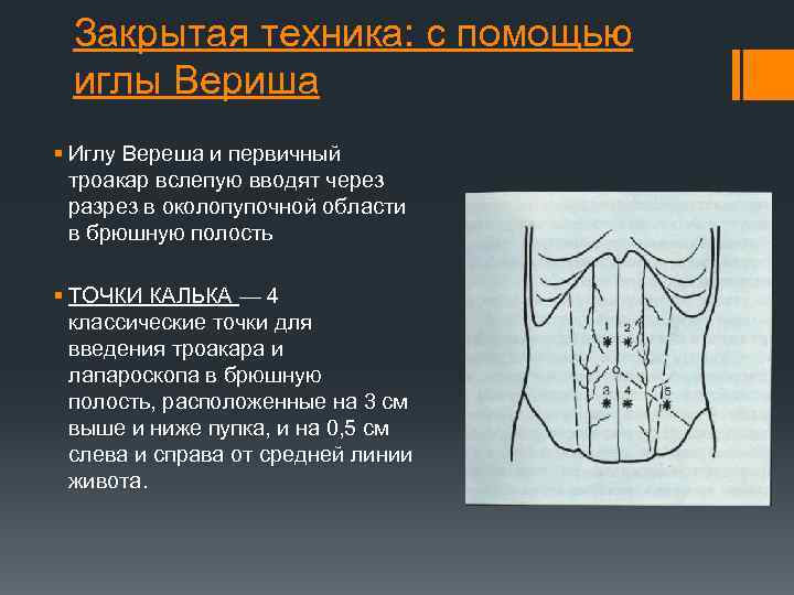 Закрытая техника: с помощью иглы Вериша § Иглу Вереша и первичный троакар вслепую вводят