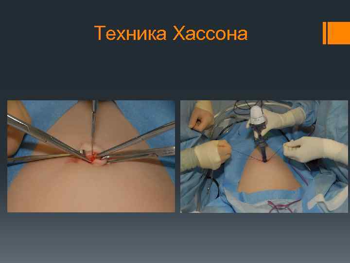 Техника Хассона 