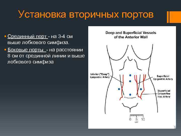 Установка вторичных портов § Срединный порт - на 3 -4 см выше лобкового симфиза.