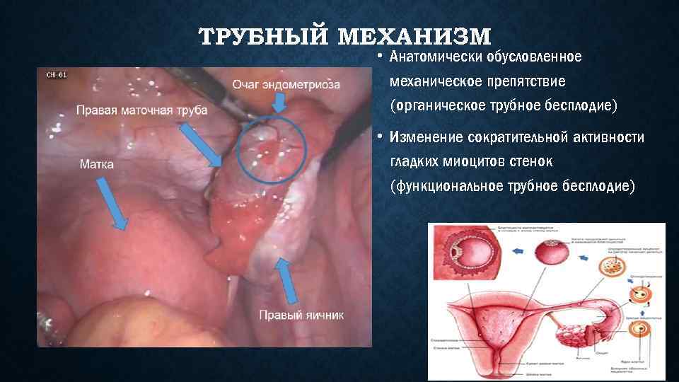 ТРУБНЫЙ МЕХАНИЗМ • Анатомически обусловленное механическое препятствие (органическое трубное бесплодие) • Изменение сократительной активности