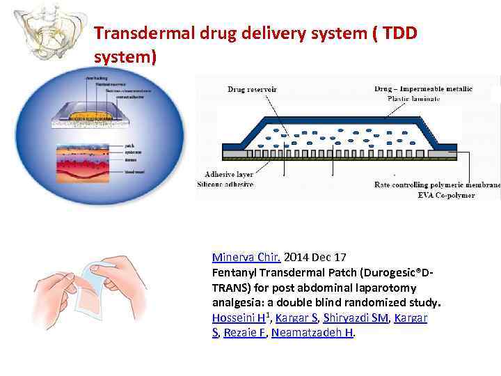 Transdermal drug delivery system ( TDD system) Minerva Chir. 2014 Dec 17 Fentanyl Transdermal