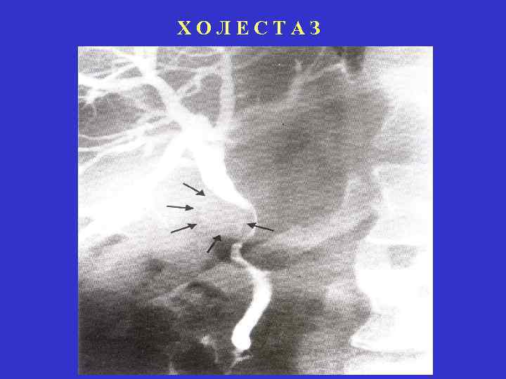 ХОЛЕСТАЗ 