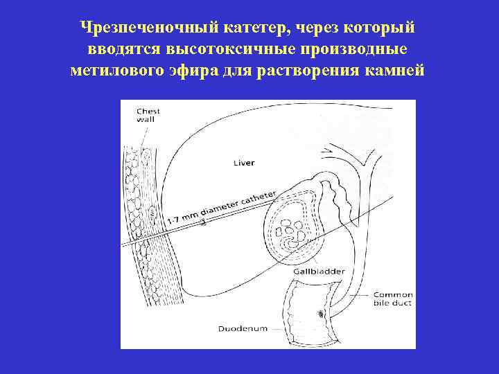 Чрезпеченочный катетер, через который вводятся высотоксичные производные метилового эфира для растворения камней 