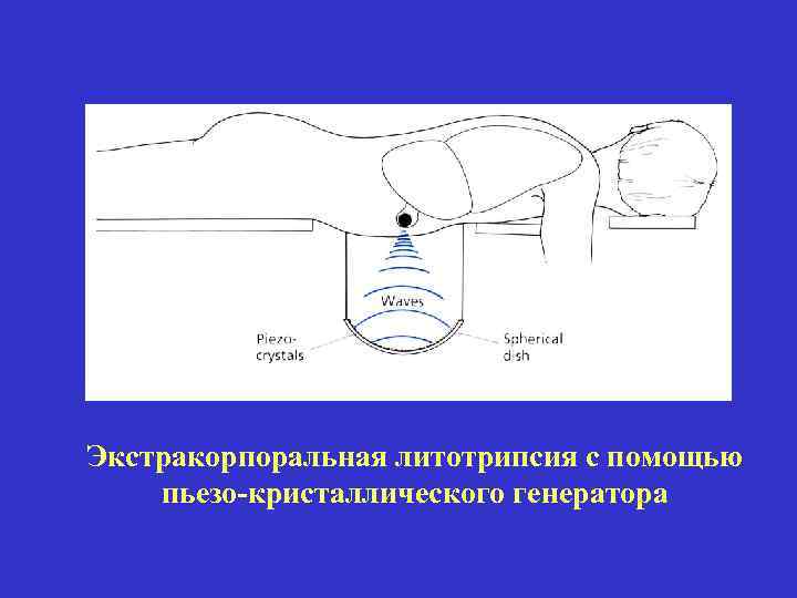 Экстракорпоральная литотрипсия с помощью пьезо-кристаллического генератора 