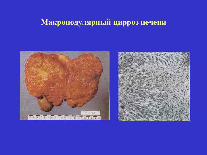 Макронодулярный цирроз печени 