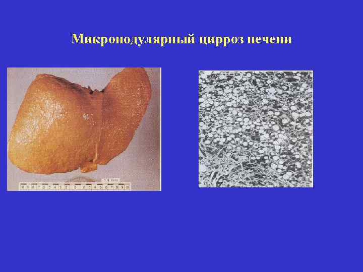 Микронодулярный цирроз печени 