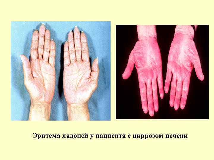 Эритема ладоней у пациента с циррозом печени 