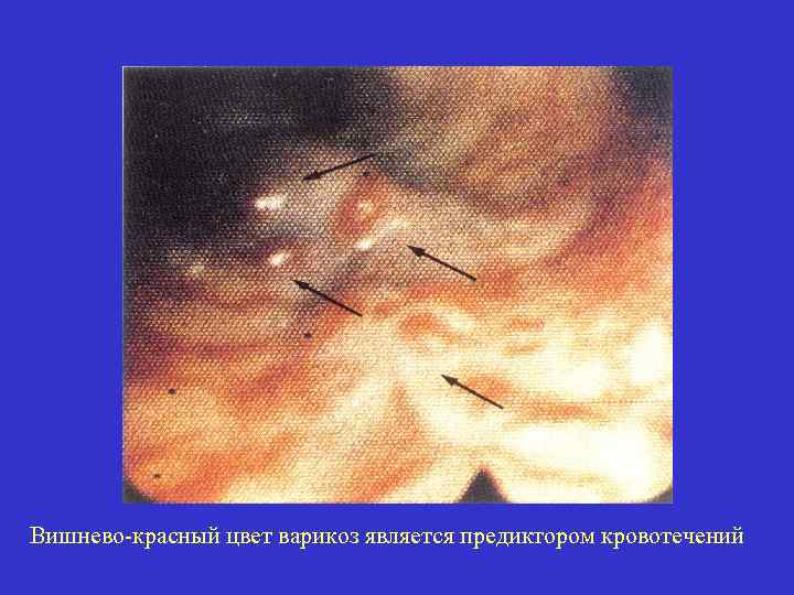 Вишнево-красный цвет варикоз является предиктором кровотечений 