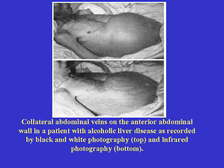 Collateral abdominal veins on the anterior abdominal wall in a patient with alcoholic liver