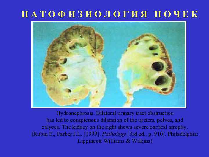 ПАТОФИЗИОЛОГИЯ ПОЧЕК Hydronephrosis. Bilateral urinary tract obstruction has led to conspicuous dilatation of the