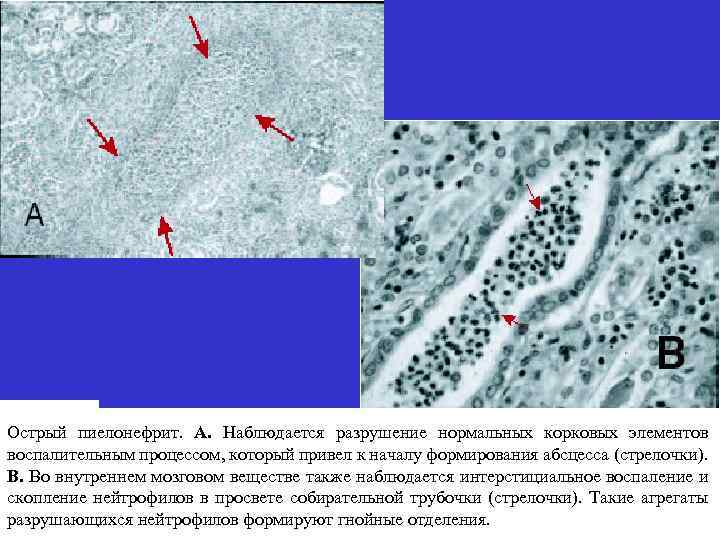 Острый пиелонефрит. А. Наблюдается разрушение нормальных корковых элементов воспалительным процессом, который привел к началу