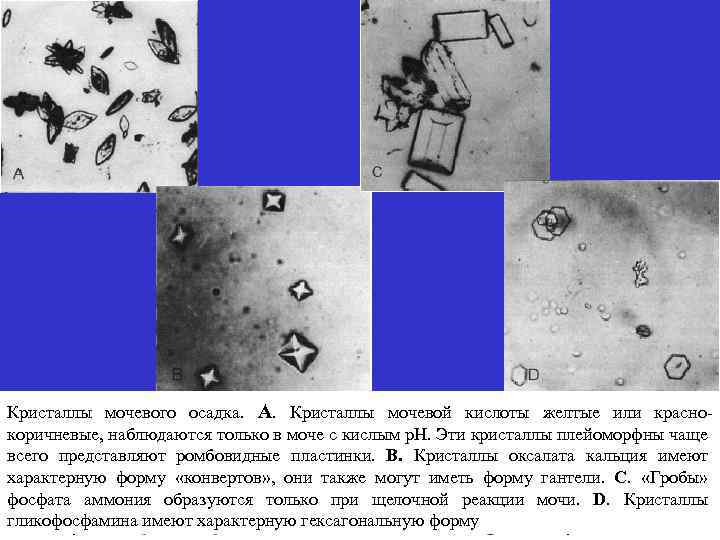 Кристаллы мочевой кислоты в моче фото