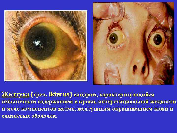 Желтуха (греч. ikterus) синдром, характеризующийся избыточным содержанием в крови, интерстициальной жидкости и моче компонентов