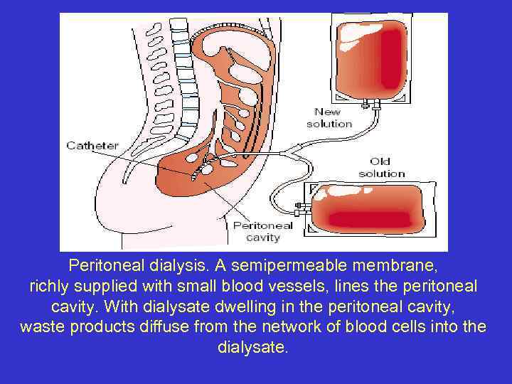 Peritoneal dialysis. A semipermeable membrane, richly supplied with small blood vessels, lines the peritoneal