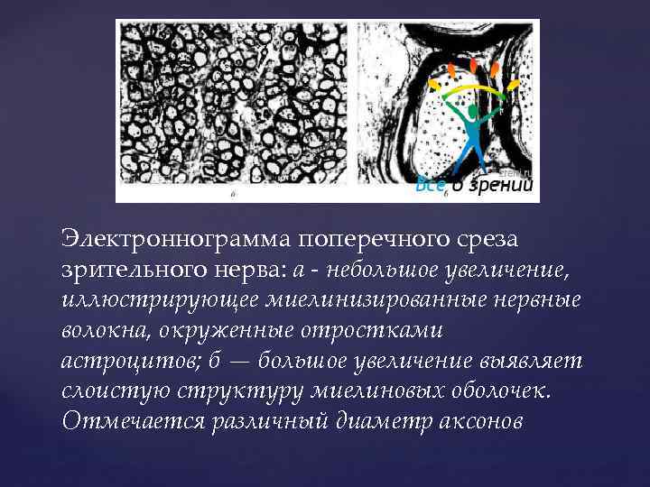 Электроннограмма поперечного среза зрительного нерва: а - небольшое увеличение, иллюстрирующее миелинизированные нервные волокна, окруженные