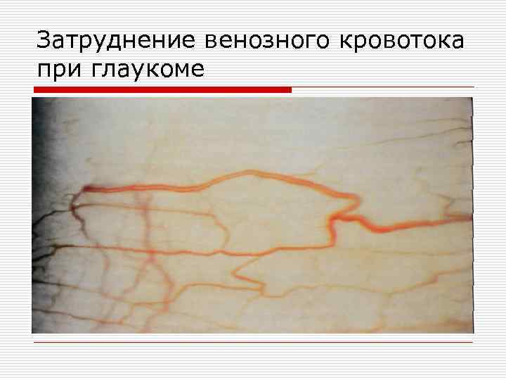 Затруднение венозного кровотока при глаукоме 