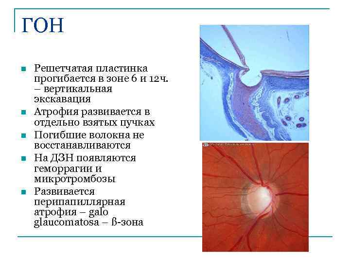 ГОН n n n Решетчатая пластинка прогибается в зоне 6 и 12 ч. –