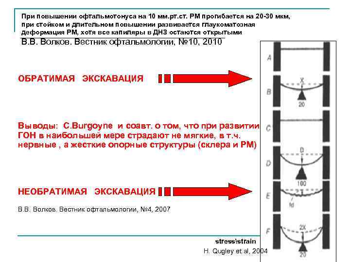 При повышении офтальмотонуса на 10 мм. рт. ст. РМ прогибается на 20 -30 мкм,