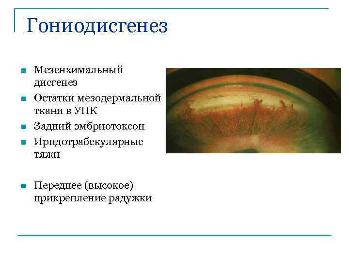 Гониодисгенез n n n Мезенхимальный дисгенез Остатки мезодермальной ткани в УПК Задний эмбриотоксон Иридотрабекулярные