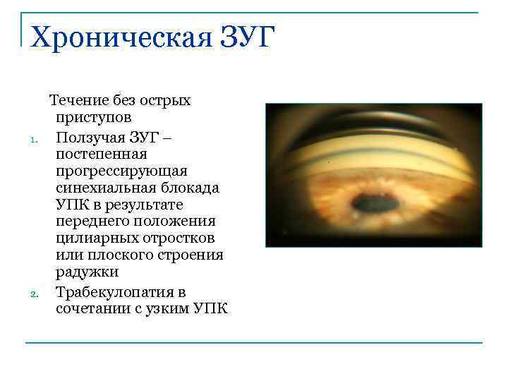 Хроническая ЗУГ 1. 2. Течение без острых приступов Ползучая ЗУГ – постепенная прогрессирующая синехиальная