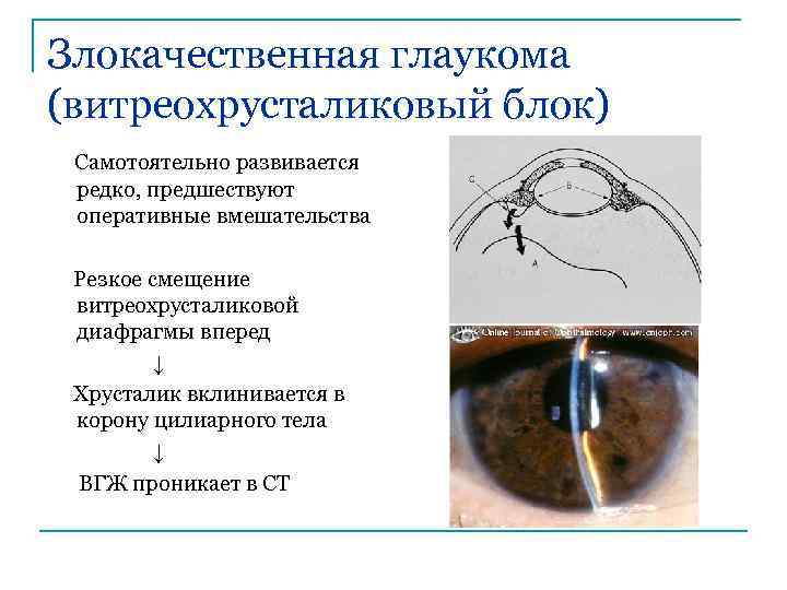 Злокачественная глаукома (витреохрусталиковый блок) Самотоятельно развивается редко, предшествуют оперативные вмешательства Резкое смещение витреохрусталиковой диафрагмы