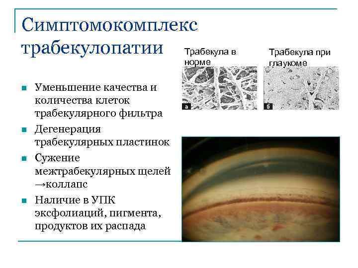 Симптомокомплекс трабекулопатии Трабекула в норме n n Уменьшение качества и количества клеток трабекулярного фильтра