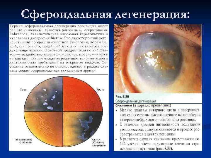 Сфероидальная дегенерация: 