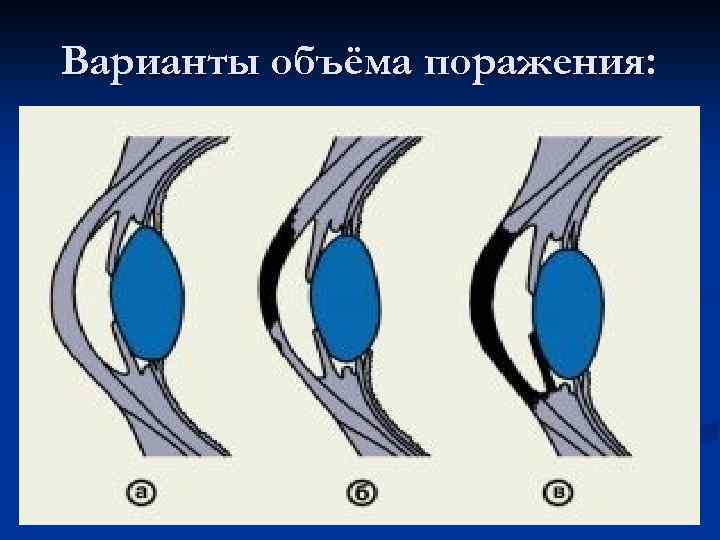 Варианты объёма поражения: 