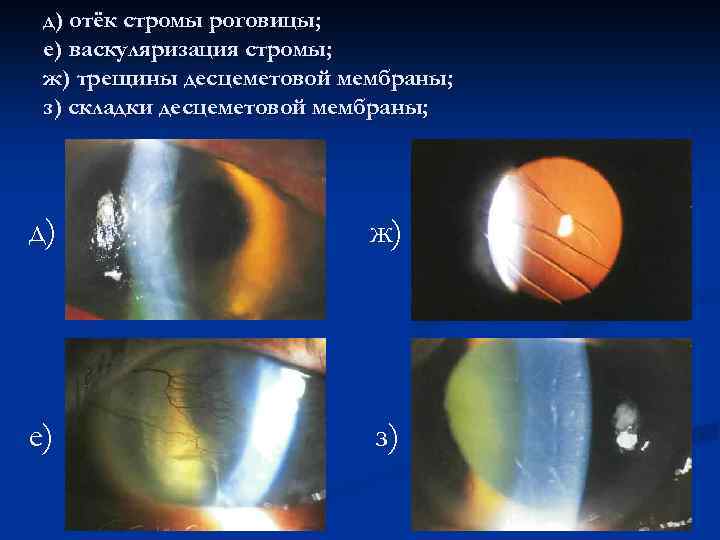 д) отёк стромы роговицы; е) васкуляризация стромы; ж) трещины десцеметовой мембраны; з) складки десцеметовой