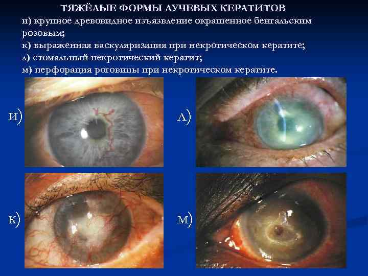 ТЯЖЁЛЫЕ ФОРМЫ ЛУЧЕВЫХ КЕРАТИТОВ и) крупное древовидное изъязвление окрашенное бенгальским розовым; к) выраженная васкуляризация