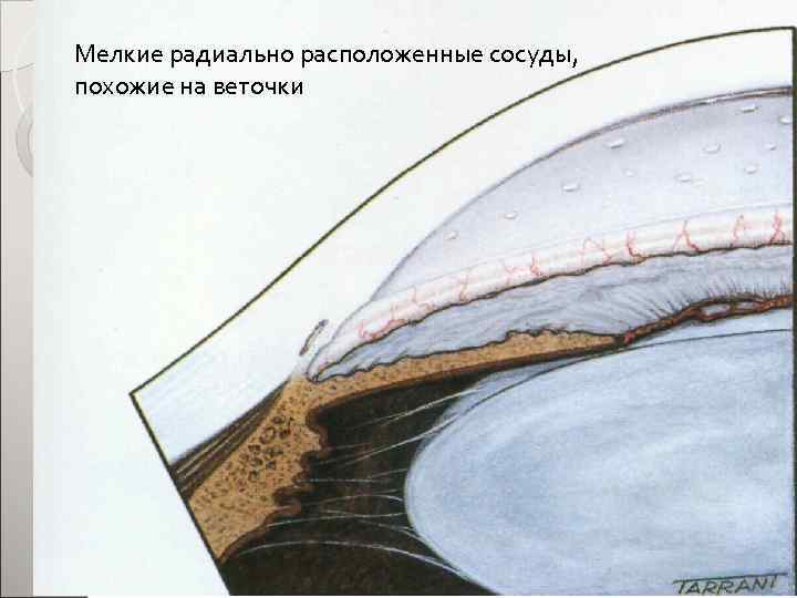 Мелкие радиально расположенные сосуды, похожие на веточки 