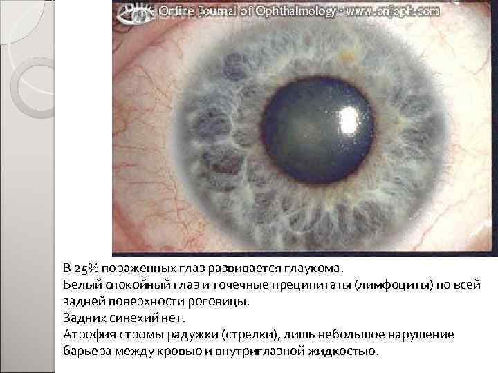 В 25% пораженных глаз развивается глаукома. Белый спокойный глаз и точечные преципитаты (лимфоциты) по