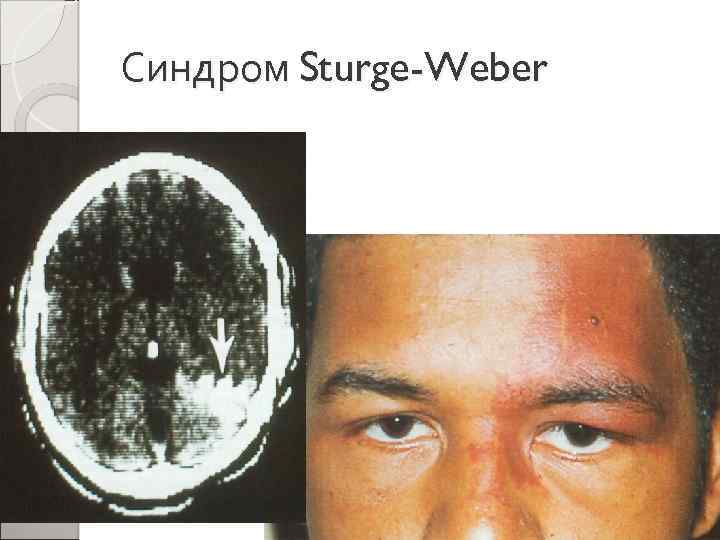 Синдром Sturge-Weber 