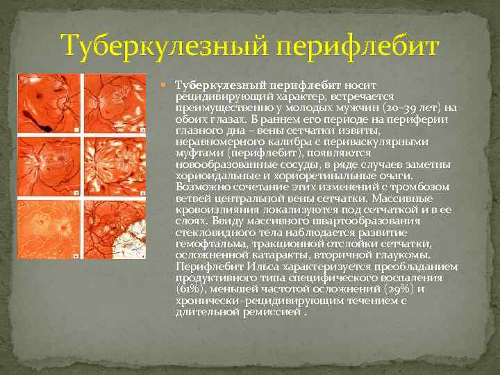 Туберкулезный перифлебит носит рецидивирующий характер, встречается преимущественно у молодых мужчин (20– 39 лет) на