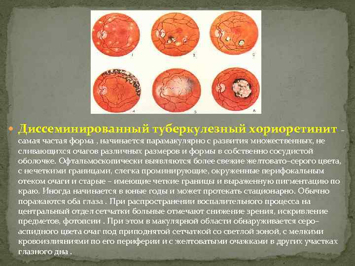  Диссеминированный туберкулезный хориоретинит – самая частая форма , начинается парамакулярно с развития множественных,