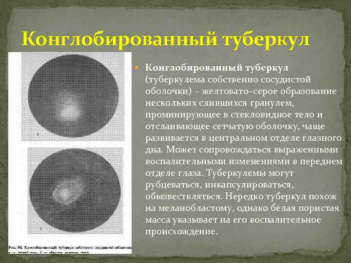 Конглобированный туберкул (туберкулема собственно сосудистой оболочки) – желтовато–серое образование нескольких слившихся гранулем, проминирующее в