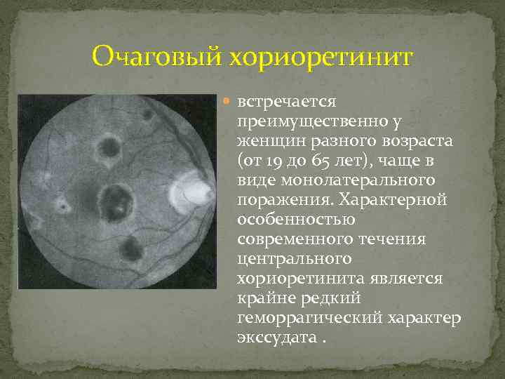 Очаговый хориоретинит встречается преимущественно у женщин разного возраста (от 19 до 65 лет), чаще