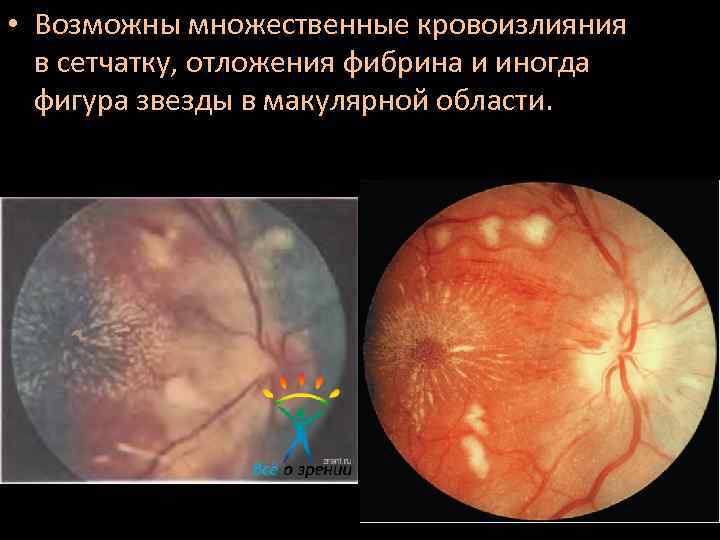  • Возможны множественные кровоизлияния в сетчатку, отложения фибрина и иногда фигура звезды в