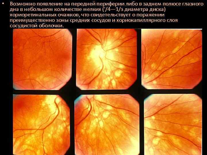  • Возможно появление на передней периферии либо в заднем полюсе глазного дна в
